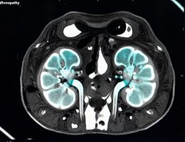 Mehran Skoru (Kontrast Nefropatisi Risk Skoru)
