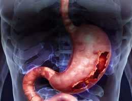 Stres İlişkili Mukozal Hasar (SİMH): Patofizyoloji, Risk Faktörleri, Tanı ve Profilaksi