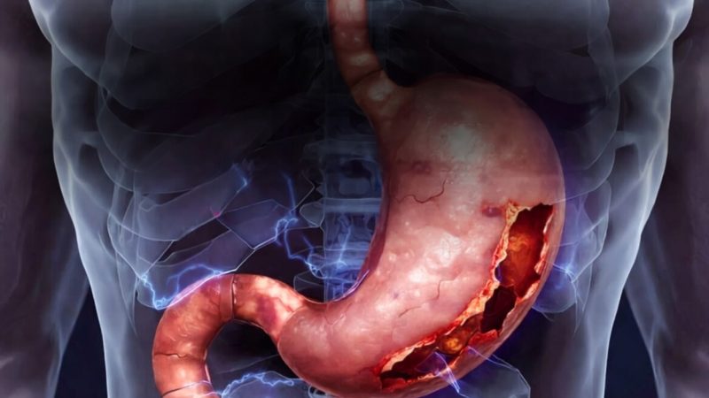 Stres İlişkili Mukozal Hasar (SİMH): Patofizyoloji, Risk Faktörleri, Tanı ve Profilaksi